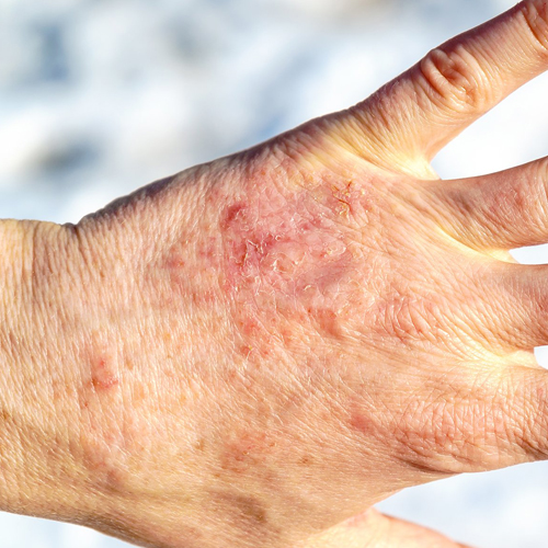 hand displaying a skin condition